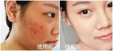 皮膚科醫(yī)生力薦 醫(yī)用面膜如何一招擺脫敏感肌困擾？