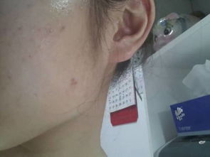 【我改善痤瘡經驗和須知你，從起步進階肌膚穩軌跡走出階段對望轉變安全】